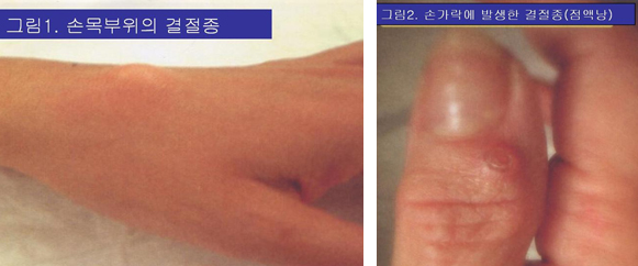 손목부위의 결절종 이미지와 손가락에 발생한 결절종 이미지