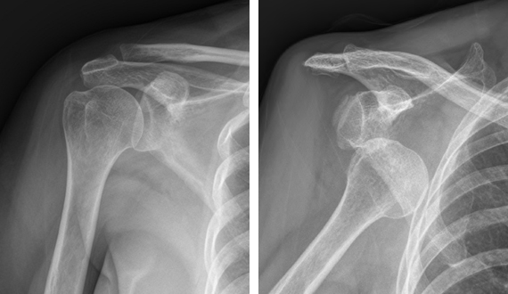 정상어깨(좌) 와 어깨가 탈구된(우) 엑스레이 사진